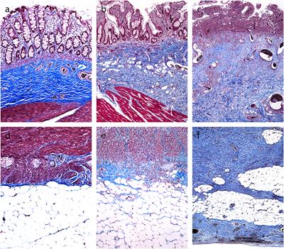 Pathology of Fibrosis in Crohn's Disease—Contribution to Understanding Its Pathogenesis